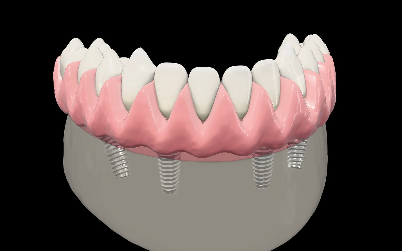 Ilustración anatómica: prótesis fija de arcada inferior sobre cuatro implantes integrados en el hueso mandibular, dos rectos al frente y dos inclinados atrás