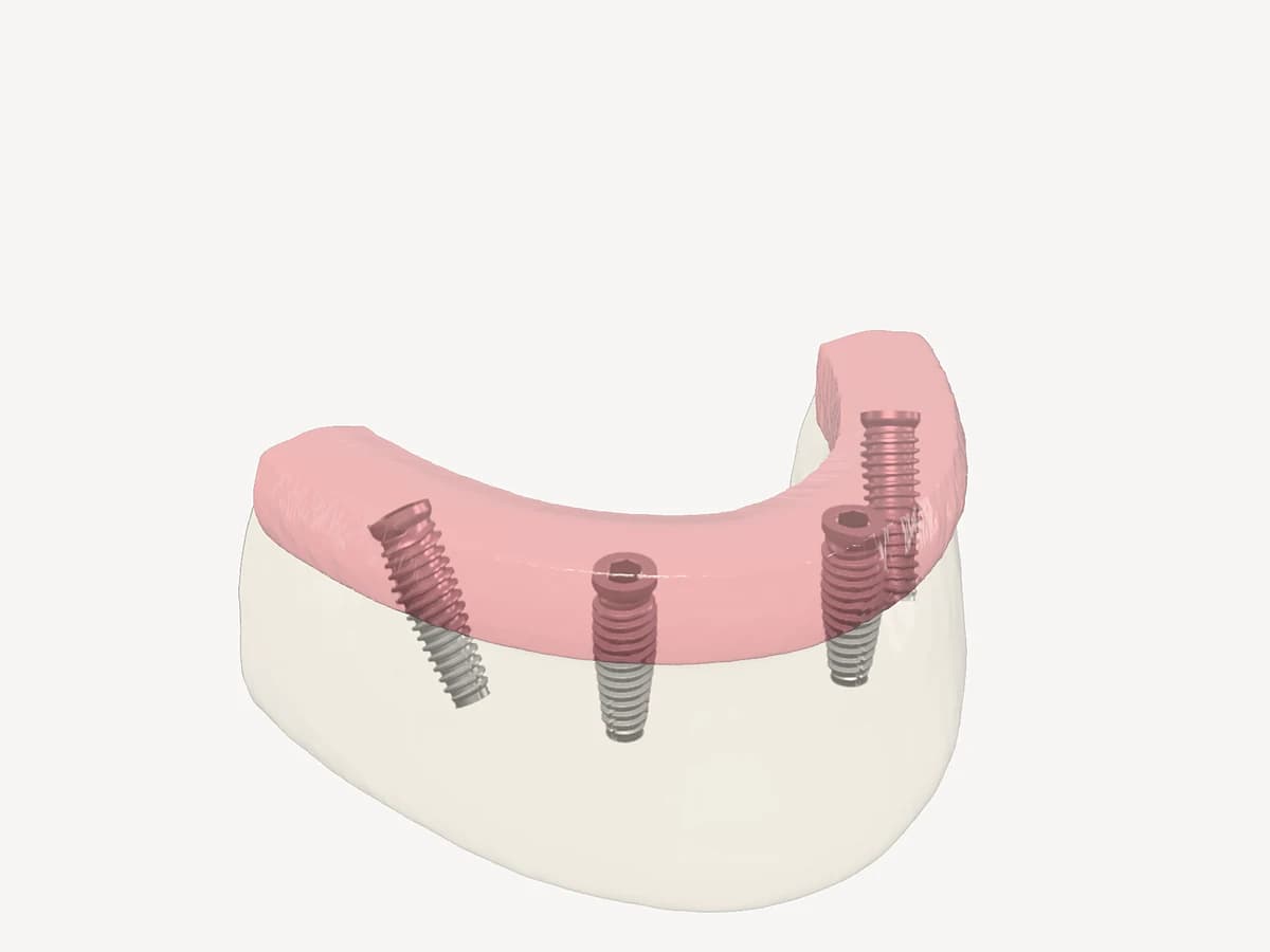 Paso 2: cuatro implantes de titanio colocados en el hueso, los posteriores inclinados