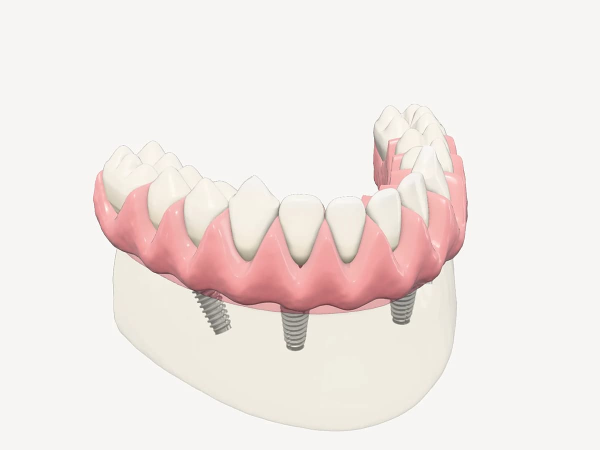 Paso 4: prótesis fija de arcada completa atornillada sobre los implantes