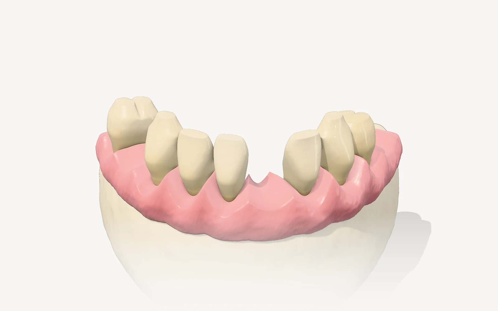 Visualización 3D de una arcada inferior con varios dientes ausentes, dientes desgastados y encía retraída